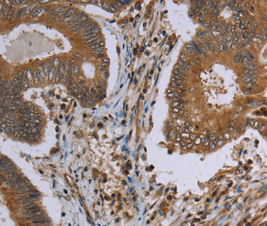 Immunohistochemistry of paraffin-embedded Human colon cancer using MAVS Polyclonal Antibody at dilution of 1:30