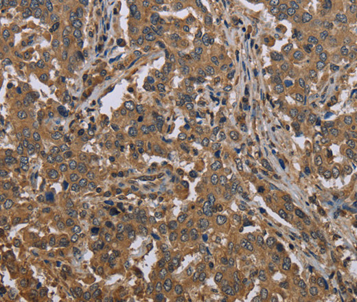 Immunohistochemistry of paraffin-embedded Human liver cancer tissue using MCC Polyclonal Antibody at dilution 1:30