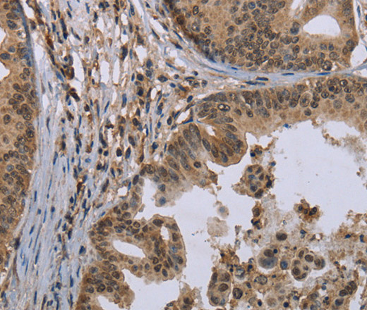 Immunohistochemistry of paraffin-embedded Human gastric cancer tissue using MCC Polyclonal Antibody at dilution 1:30