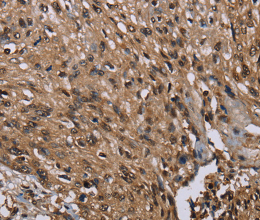 Immunohistochemistry of paraffin-embedded Human esophagus cancer tissue using MEIS1 Polyclonal Antibody at dilution 1:40