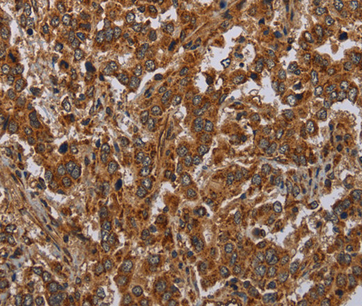 Immunohistochemistry of paraffin-embedded Human liver cancer tissue using ATP2A1 Polyclonal Antibody at dilution 1:30