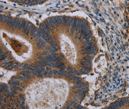 Immunohistochemistry of paraffin-embedded Human colon cancer using MAP3K11 Polyclonal Antibody at dilution of 1:40