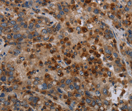 Immunohistochemistry of paraffin-embedded Human liver cancer using MAP3K11 Polyclonal Antibody at dilution of 1:40