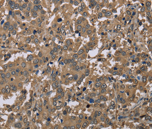 Immunohistochemistry of paraffin-embedded Human liver cancer using CAB39 Polyclonal Antibody at dilution of 1:40