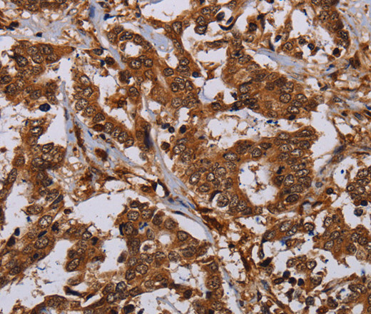 Immunohistochemistry of paraffin-embedded Human liver cancer using MOB1A Polyclonal Antibody at dilution of 1:30