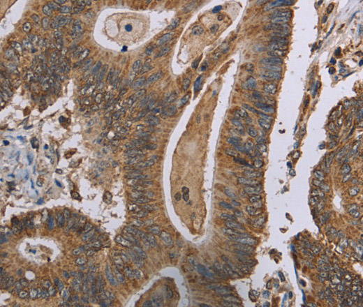 Immunohistochemistry of paraffin-embedded Human colon cancer tissue using MRGPRX1 Polyclonal Antibody at dilution 1:40