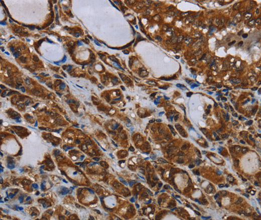 Immunohistochemistry of paraffin-embedded Human thyroid cancer tissue using MT-ND1 Polyclonal Antibody at dilution 1:30