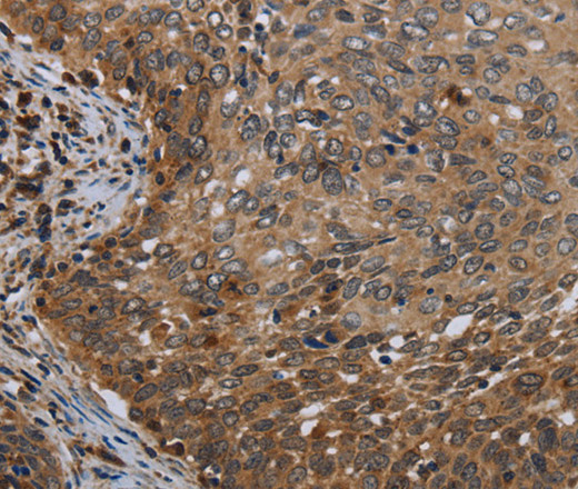 Immunohistochemistry of paraffin-embedded Human cervical cancer tissue using MT-ND6 Polyclonal Antibody at dilution 1:40