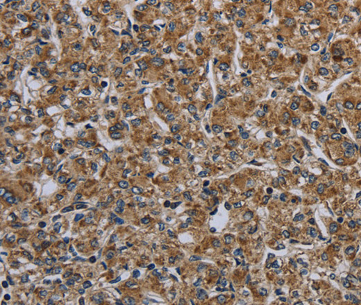 Immunohistochemistry of paraffin-embedded Human prostate cancer tissue using MYO7A Polyclonal Antibody at dilution 1:30