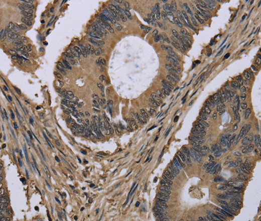 Immunohistochemistry of paraffin-embedded Human colon cancer tissue using MYO18B Polyclonal Antibody at dilution 1:50