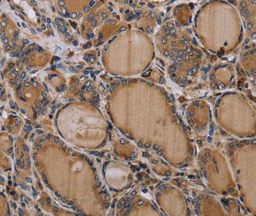 Immunohistochemistry of paraffin-embedded Human thyroid cancer tissue using NLRP4 Polyclonal Antibody at dilution 1:30