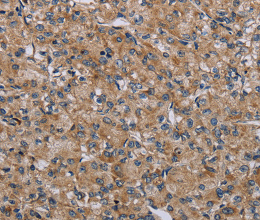 Immunohistochemistry of paraffin-embedded Human prostate cancer tissue using NLRP4 Polyclonal Antibody at dilution 1:30