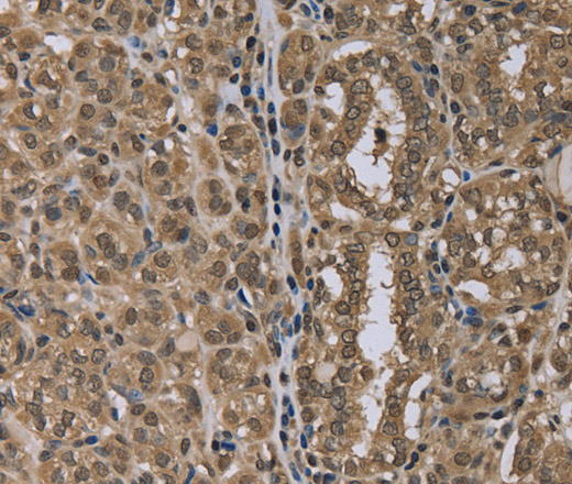 Immunohistochemistry of paraffin-embedded Human thyroid cancer tissue using NLRP6 Polyclonal Antibody at dilution 1:40