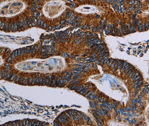 Immunohistochemistry of paraffin-embedded Human colon cancer using NDUFA4 Polyclonal Antibody at dilution of 1:40