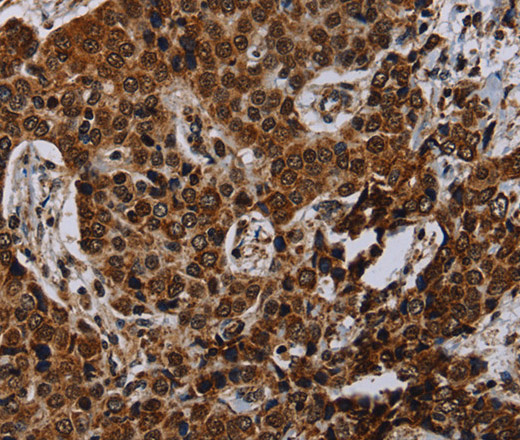 Immunohistochemistry of paraffin-embedded Human liver cancer using NDUFA4 Polyclonal Antibody at dilution of 1:40