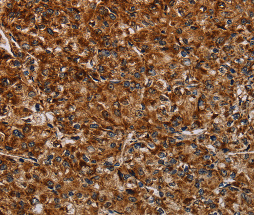 Immunohistochemistry of paraffin-embedded Human prostate cancer tissue using NDUFAB1 Polyclonal Antibody at dilution 1:40