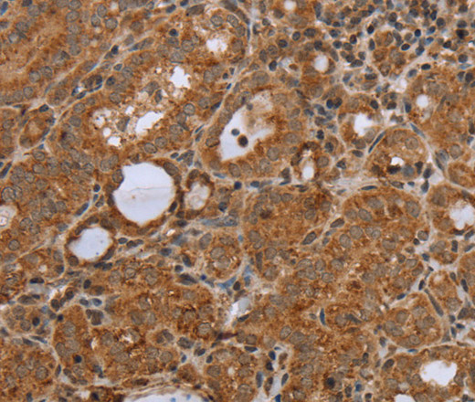 Immunohistochemistry of paraffin-embedded Human thyroid cancer using NDUFS2 Polyclonal Antibody at dilution of 1:50