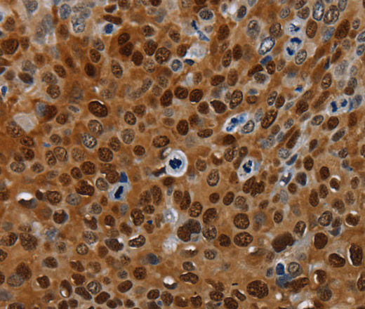 Immunohistochemistry of paraffin-embedded Human cervical cancer tissue using NRP2 Polyclonal Antibody at dilution 1:35