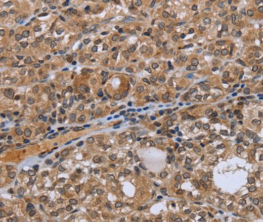 Immunohistochemistry of paraffin-embedded Human thyroid cancer tissue using NRP2 Polyclonal Antibody at dilution 1:35