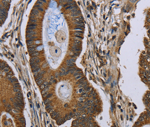 Immunohistochemistry of paraffin-embedded Human colon cancer tissue using NEFH Polyclonal Antibody at dilution 1:40