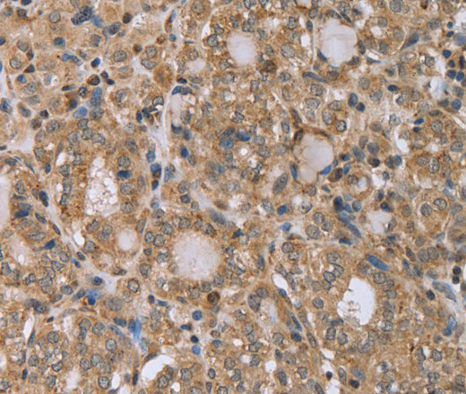 Immunohistochemistry of paraffin-embedded Human thyroid cancer tissue using RAB39B Polyclonal Antibody at dilution 1:45