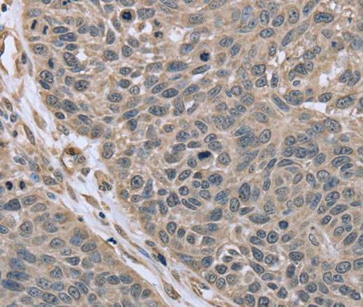 Immunohistochemistry of paraffin-embedded Human lung cancer using RHEB Polyclonal Antibody at dilution of 1:40