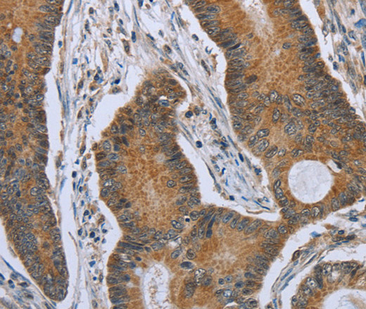 Immunohistochemistry of paraffin-embedded Human colon cancer tissue using TNFRSF13C Polyclonal Antibody at dilution 1:40