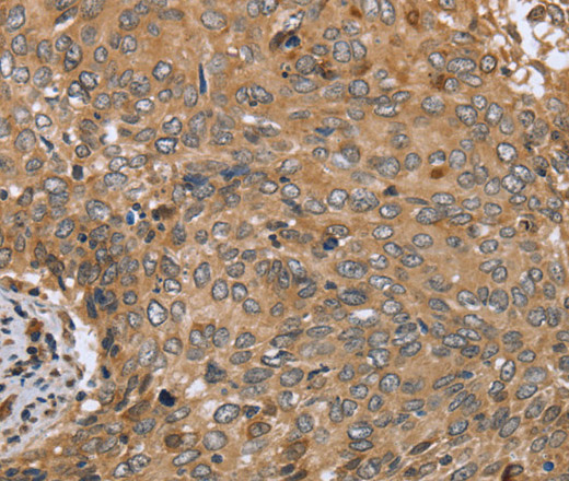 Immunohistochemistry of paraffin-embedded Human cervical cancer tissue using CLEC16A Polyclonal Antibody at dilution 1:45