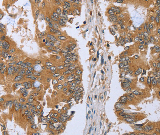 Immunohistochemistry of paraffin-embedded Human colon cancer tissue using CLEC16A Polyclonal Antibody at dilution 1:45