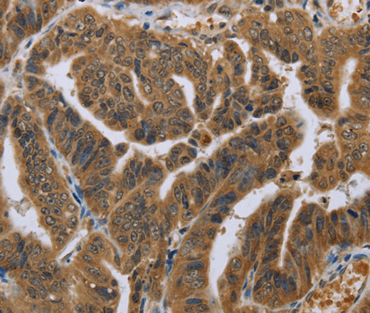 Immunohistochemistry of paraffin-embedded Human gastric cancer tissue using NLRP10 Polyclonal Antibody at dilution 1:45