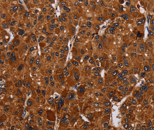 Immunohistochemistry of paraffin-embedded Human liver cancer tissue using RTN4R Polyclonal Antibody at dilution 1:50