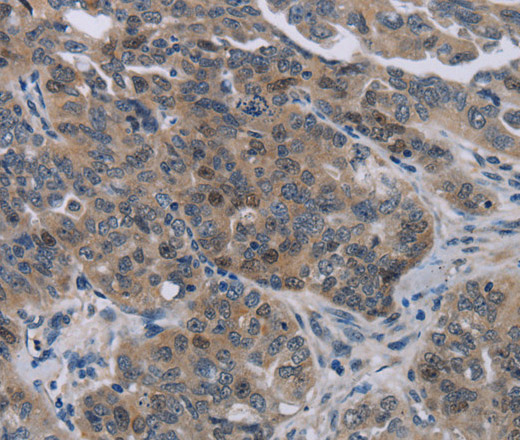 Immunohistochemistry of paraffin-embedded Human ovarian cancer tissue using NOX1 Polyclonal Antibody at dilution 1:50