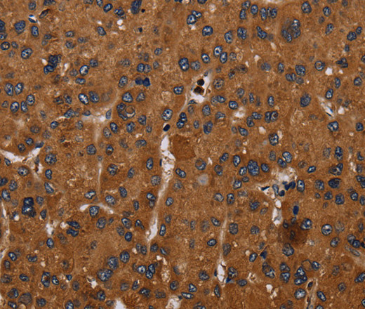 Immunohistochemistry of paraffin-embedded Human liver cancer tissue using CYBB Polyclonal Antibody at dilution 1:50