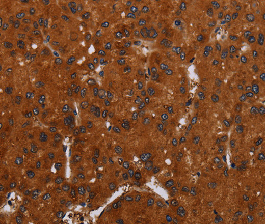 Immunohistochemistry of paraffin-embedded Human liver cancer tissue using NOX3 Polyclonal Antibody at dilution 1:30