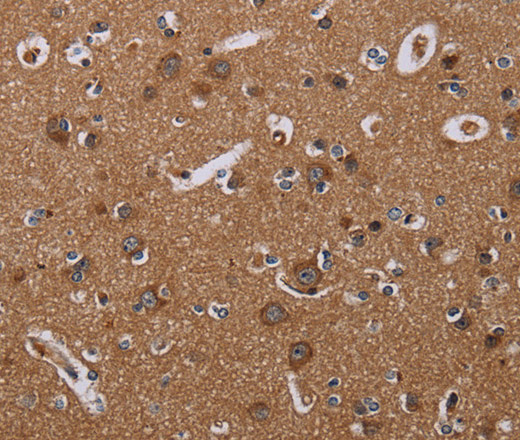 Immunohistochemistry of paraffin-embedded Human esophagus cancer tissue using NOX3 Polyclonal Antibody at dilution 1:30