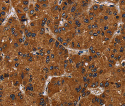 Immunohistochemistry of paraffin-embedded Human liver cancer tissue using NPHS2 Polyclonal Antibody at dilution 1:40