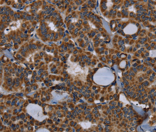 Immunohistochemistry of paraffin-embedded Human thyroid cancer tissue using NPHS2 Polyclonal Antibody at dilution 1:40