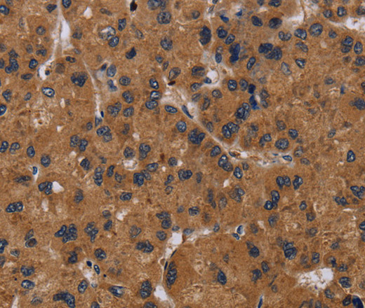 Immunohistochemistry of paraffin-embedded Human liver cancer tissue using NPRL2 Polyclonal Antibody at dilution 1:50