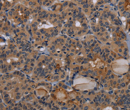 Immunohistochemistry of paraffin-embedded Human thyroid cancer tissue using NPRL2 Polyclonal Antibody at dilution 1:50