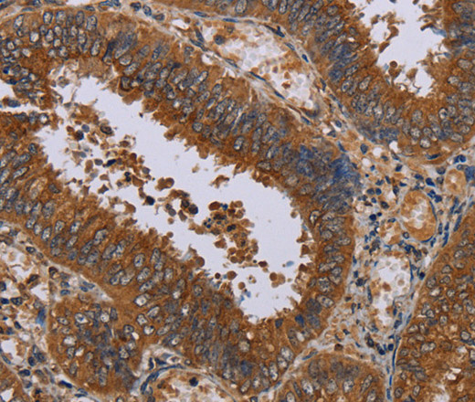 Immunohistochemistry of paraffin-embedded Human colon cancer tissue using NPTX1 Polyclonal Antibody at dilution 1:50