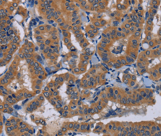 Immunohistochemistry of paraffin-embedded Human thyroid cancer tissue using NPTX1 Polyclonal Antibody at dilution 1:50