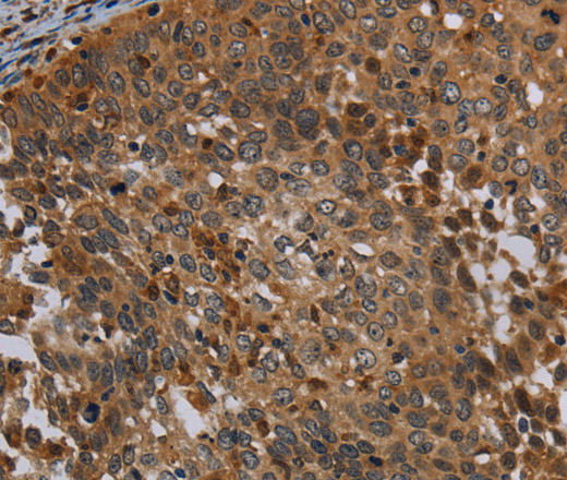 Immunohistochemistry of paraffin-embedded Human cervical cancer tissue using OSM Polyclonal Antibody at dilution 1:30