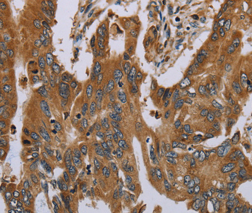 Immunohistochemistry of paraffin-embedded Human colon cancer tissue using OSM Polyclonal Antibody at dilution 1:30