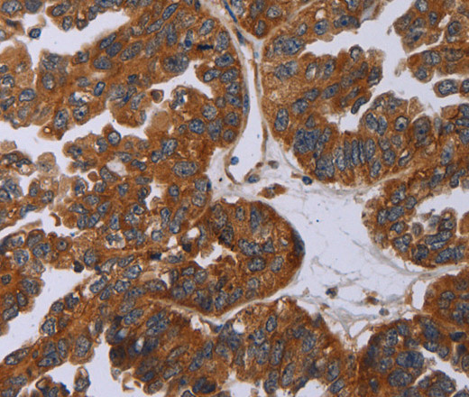 Immunohistochemistry of paraffin-embedded Human liver cancer tissue using P2RY2 Polyclonal Antibody at dilution of 1:30