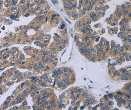 Immunohistochemistry of paraffin-embedded Human ovarian cancer tissue using TP53AIP1 Polyclonal Antibody at dilution 1:50