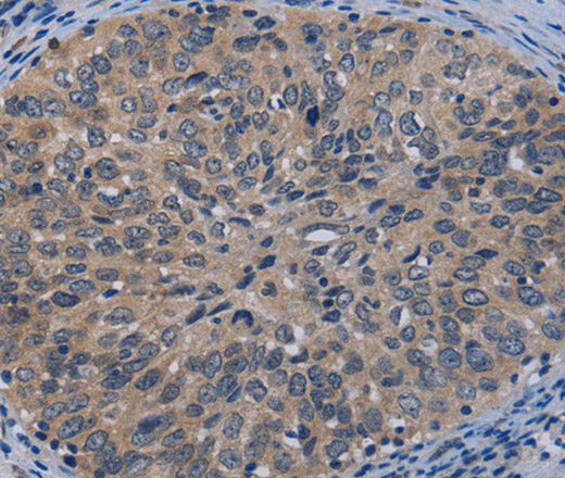 Immunohistochemistry of paraffin-embedded Human cervical cancer tissue using TP53AIP1 Polyclonal Antibody at dilution 1:50