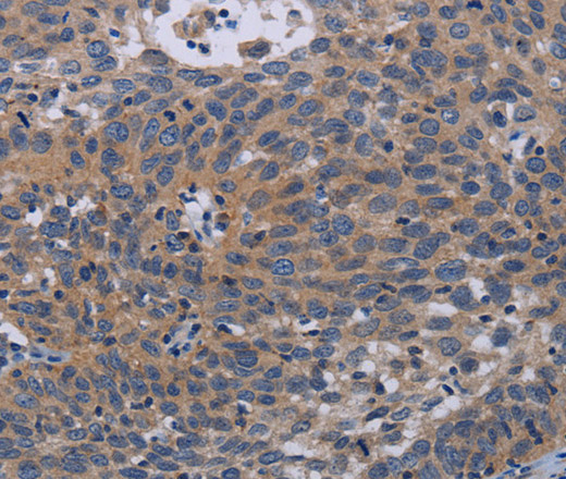 Immunohistochemistry of paraffin-embedded Human cervical cancer tissue using PAPPA Polyclonal Antibody at dilution of 1:50