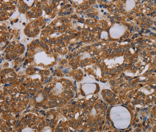 Immunohistochemistry of paraffin-embedded Human thyroid cancer tissue using PARP8 Polyclonal Antibody at dilution 1:40