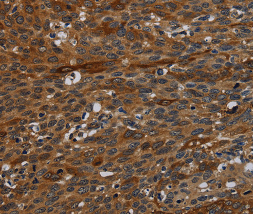 Immunohistochemistry of paraffin-embedded Human cervical cancer tissue using IVL Polyclonal Antibody at dilution 1:50