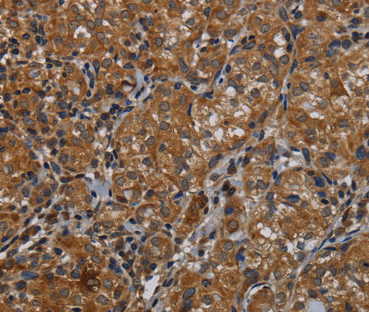 Immunohistochemistry of paraffin-embedded Human thyroid cancer tissue using IVL Polyclonal Antibody at dilution 1:50